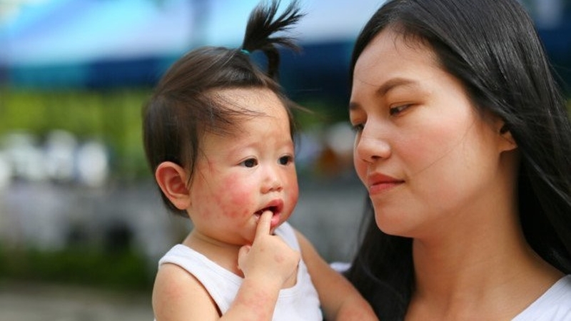 Những thông tin cần thiết khi trẻ bị tay chân miệng nhưng không sốt 1