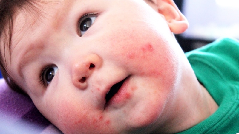 Những thông tin cần thiết khi trẻ bị tay chân miệng nhưng không sốt 3