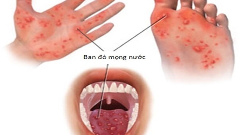 Những thông tin cần thiết khi trẻ bị tay chân miệng nhưng không sốt 2