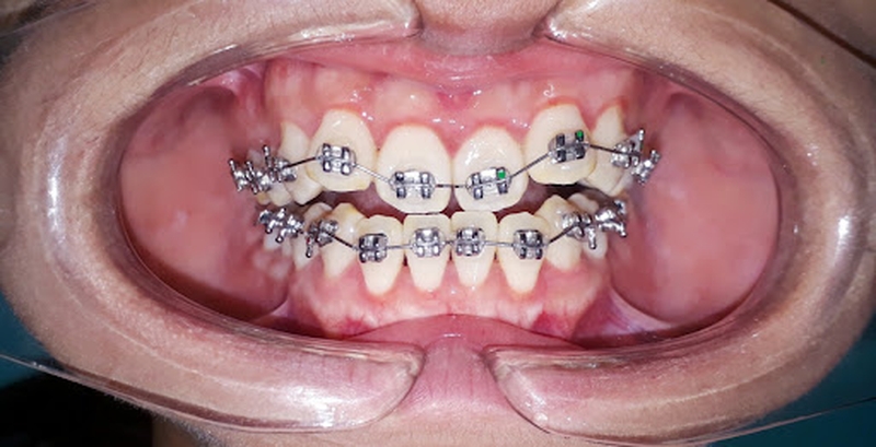 Những thông tin chia sẻ về vấn đề niềng răng lệch khớp cắn mà bạn cần quan tâm 2