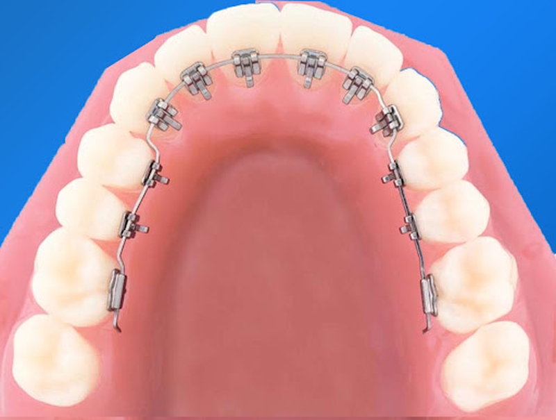 Những thông tin chia sẻ về vấn đề niềng răng lệch khớp cắn mà bạn cần quan tâm 3