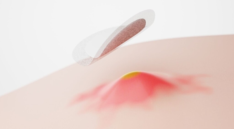 Những thông tin cơ bản về tình trạng nổi mụn sau khi tiêm vắc-xin 1