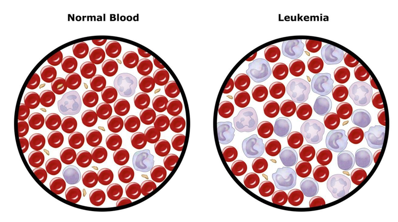 Những thông tin nên biết về phác đồ điều trị ung thư máu 3