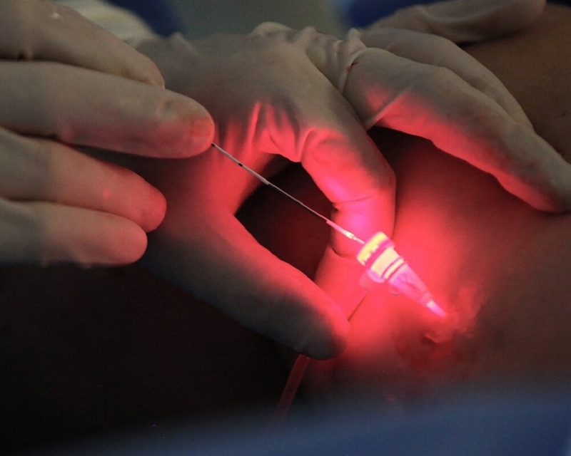 Những thông tin quan trọng bạn cần biết về phương pháp laser tĩnh mạch 4