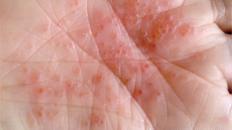 Những thuốc trị tổ đỉa á sừng nhanh chóng và hiệu quả 1