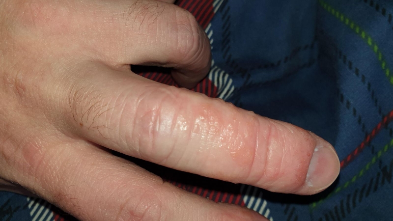 Tổ đỉa á sừng bàn tay gây ngứa ngáy, khó chịu 2