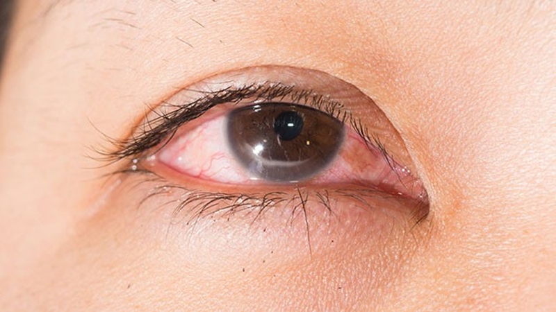 Triệu chứng bị lông quặm bạn cần biết để điều trị kịp thời 1