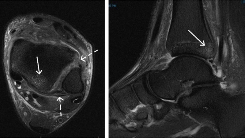 Nhận biết sớm các triệu chứng bong gân để xử lý hiệu quả 5