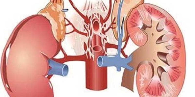 Những triệu chứng đầu tiên của bệnh suy thận cấp