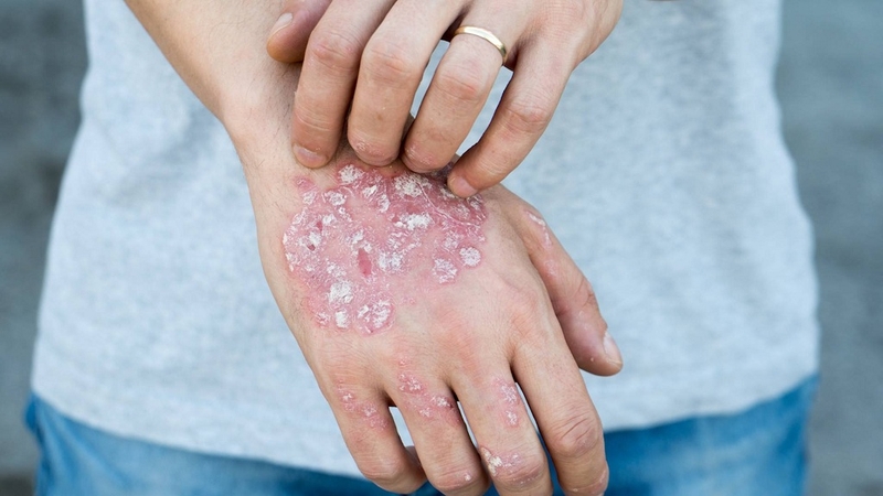 Những triệu chứng hạ canxi nào mà bạn cần biết 2