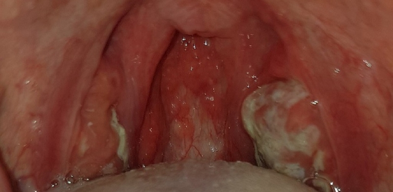 Những triệu chứng phổ biến nhất phân biệt phân biệt bạch hầu và viêm họng 1