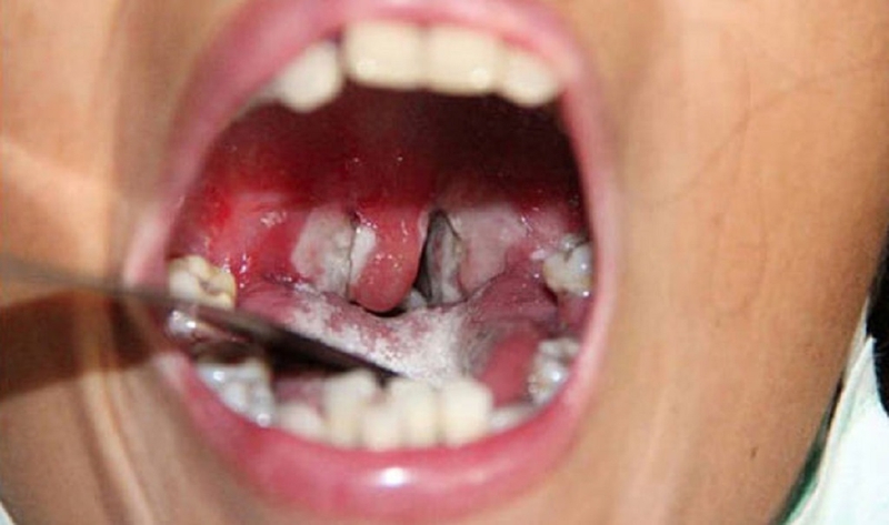 Những triệu chứng phổ biến nhất phân biệt phân biệt bạch hầu và viêm họng 2