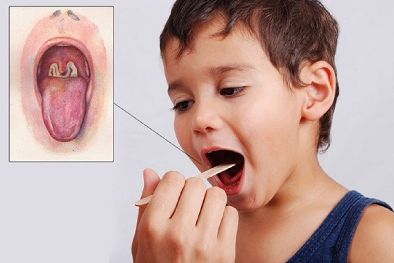 Những triệu chứng phổ biến nhất phân biệt phân biệt bạch hầu và viêm họng 3