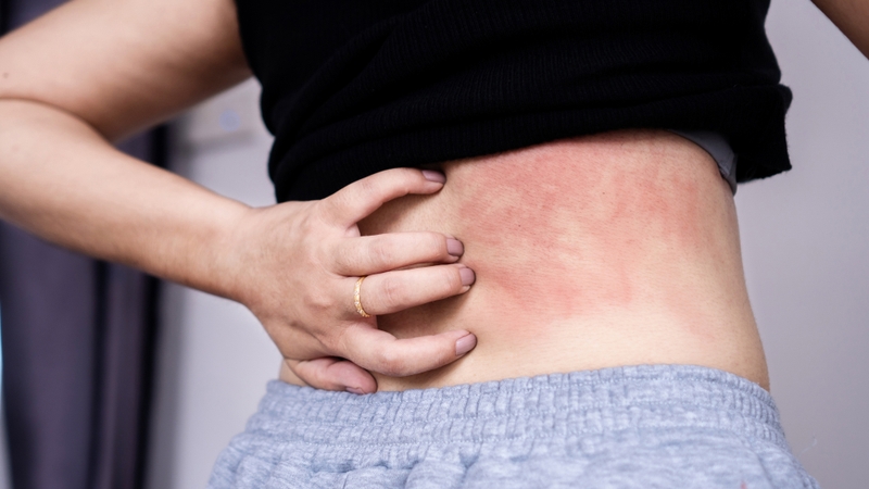 Những triệu chứng sán chó ở người mà bạn cần lưu ý 1