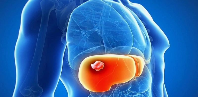 nhung-trieu-chung-va-nguyen-nhan-gay-u-gan-ac-tinh-la-gi 1.jpg