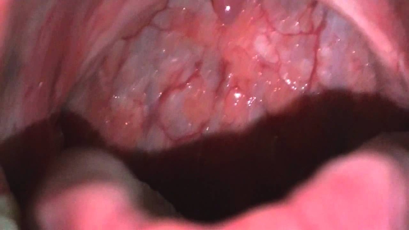 Những triệu chứng viêm họng hạt bạn cần nắm rõ để nhận biết bệnh 2