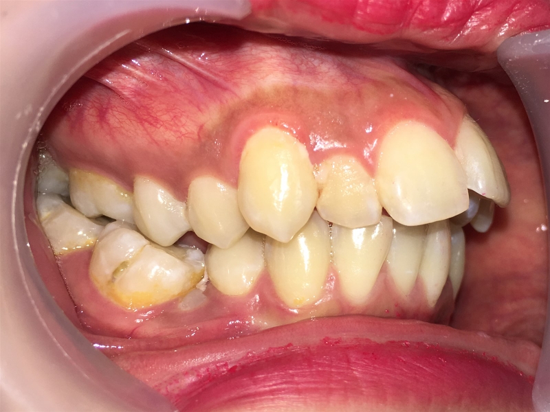 Những ưu và nhược điểm khi dán sứ không mài răng3