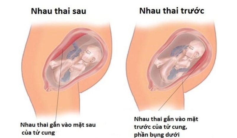 Những vấn đề mẹ bầu cần lưu ý về tình trạng nhau bám mặt trước 1