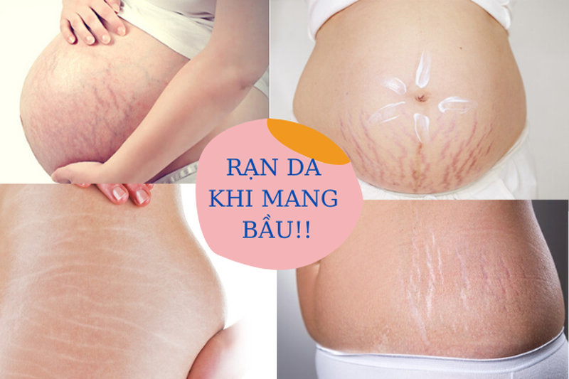 Những vùng da dễ bị rạn nhất bạn cần chú ý