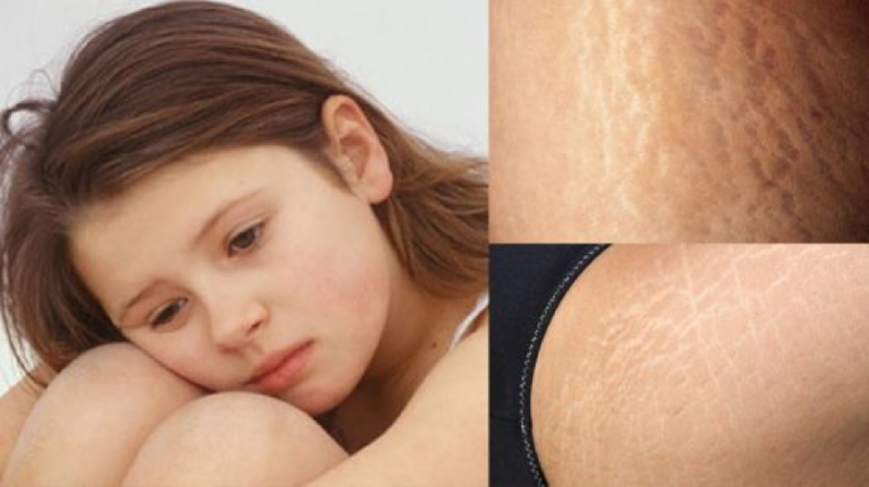 Những vùng da dễ bị rạn nhất bạn cần chú ý