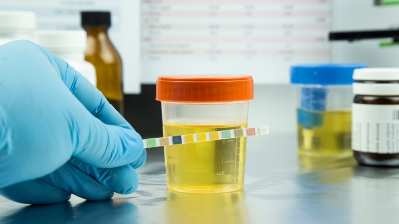 Những yếu tố ảnh hưởng đến kết quả xét nghiệm nước tiểu bạn cần biết 1