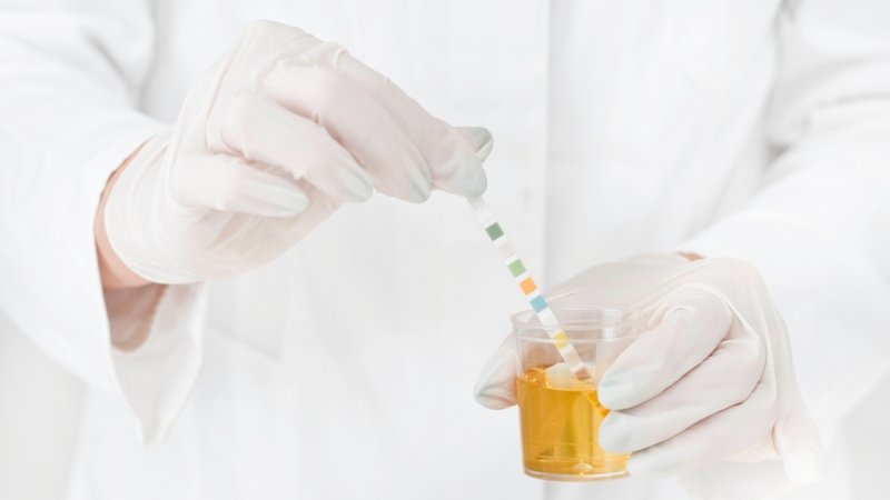 Những yếu tố ảnh hưởng đến kết quả xét nghiệm nước tiểu bạn cần biết 3