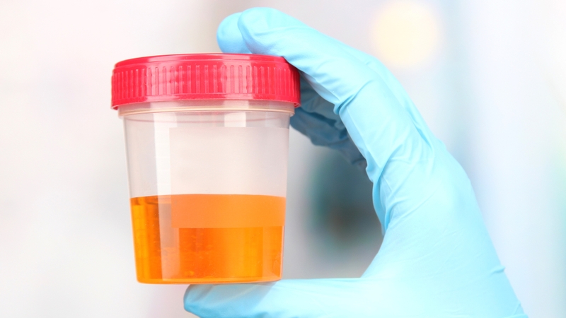 Những yếu tố ảnh hưởng đến kết quả xét nghiệm nước tiểu bạn cần biết 5