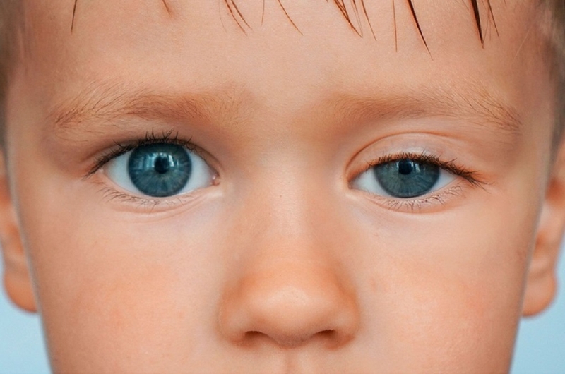 Nhược cơ mắt bẩm sinh: Dấu hiệu nhận biết sớm nhất và cách điều trị hiệu quả 1