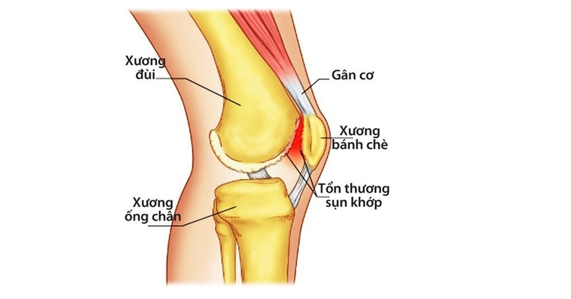Nhuyễn sụn bánh chè: Nguyên nhân, triệu chứng, cách điều trị và biện pháp phòng ngừa 1