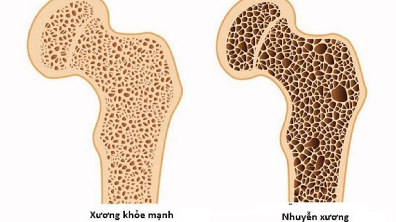 Nhuyễn xương là gì? Cách phân biệt nhuyễn xương và loãng xương 1
