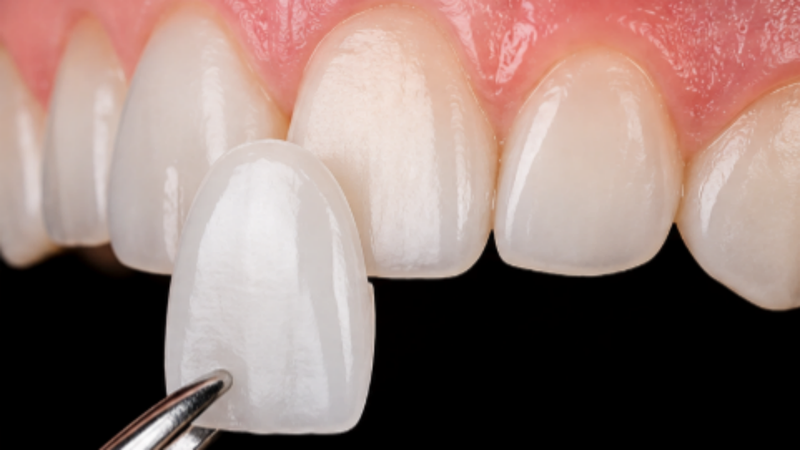 Dán sứ veneer có thể được chọn để thay thế cho việc chỉ niềng riêng 2 răng cửa