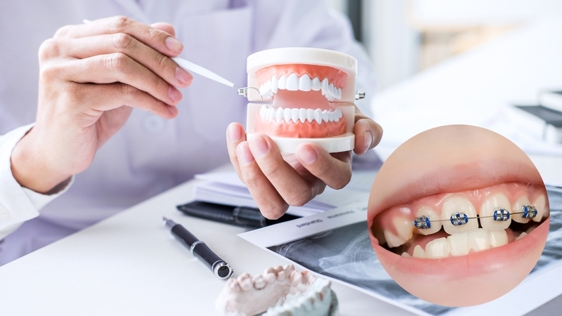 Đi tìm câu trả lời cho câu hỏi niềng 4 răng cửa được không