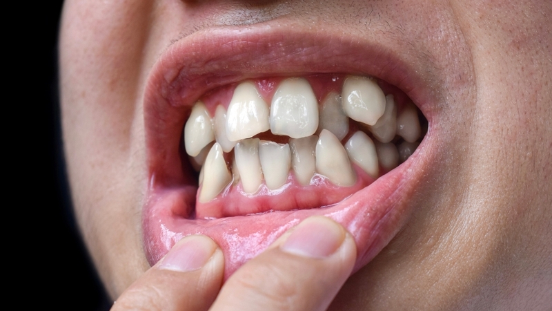 Không nên niềng 4 răng cửa khi răng lệch nhiều hoặc ảnh hưởng toàn hàm