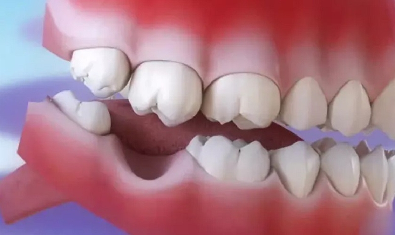 Niềng kéo răng khôn thay thế răng số 7 có được không? 3