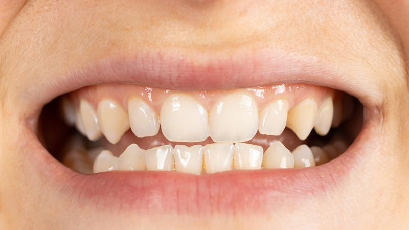 Niềng răng 10 triệu liệu có đảm bảo an toàn và đạt hiệu quả không? 5