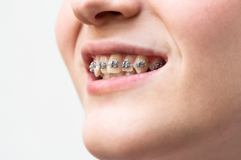 Niềng răng 1 hàm mất bao lâu? 5 yếu tố ảnh hưởng trực tiếp 2