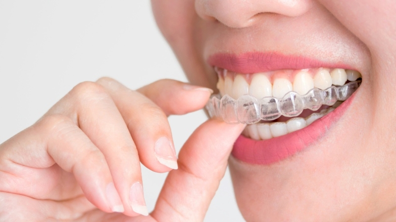 Niềng răng 1 hàm trên có được không? Nên niềng bằng phương pháp nào? 3