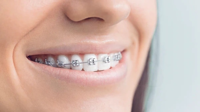 Niềng răng 1 hàm trên có được không? Nên niềng bằng phương pháp nào? 1