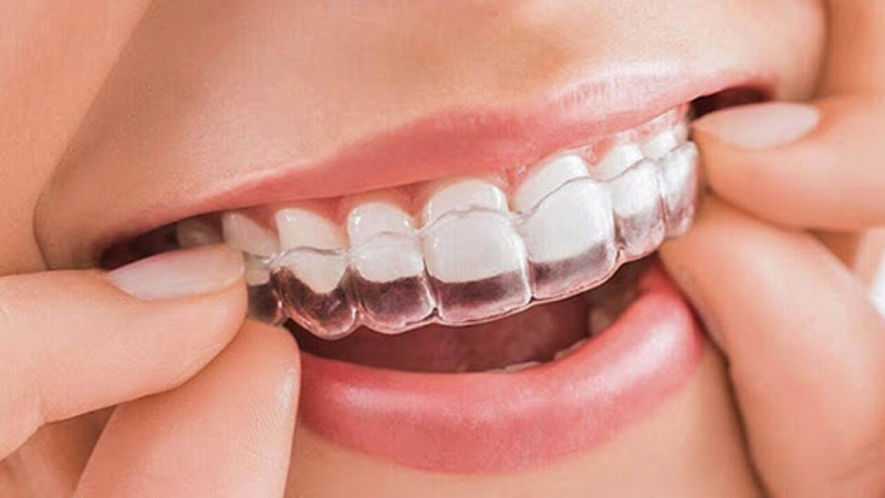 Niềng răng 3D clear là gì có hiệu quả hay không 1