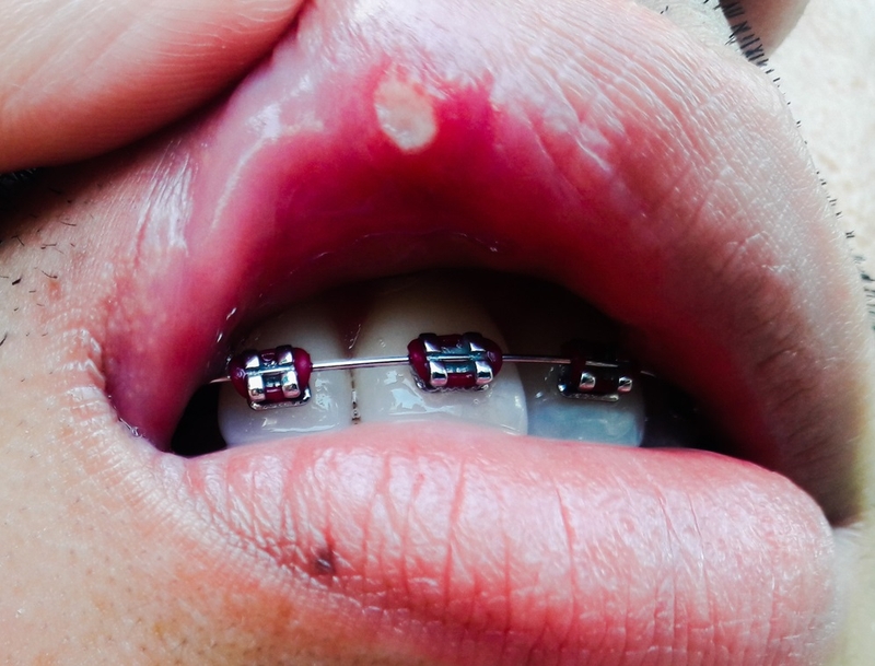 Niềng răng bị nhiệt miệng: Nguyên nhân, cách điều trị và phòng ngừa 1