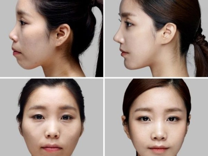 Niềng răng có cải thiện mặt lệch không 2