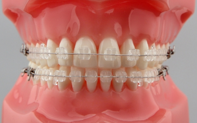 Niềng răng có cải thiện mặt lệch không 3