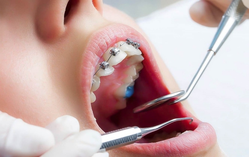 Niềng răng có được vĩnh viễn không? Các phương pháp niềng răng hiệu quả nhất 3