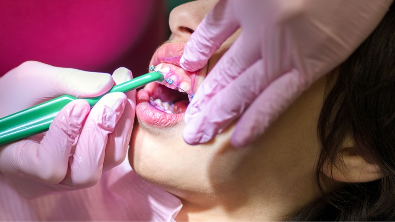 Niềng răng có giữ được răng khểnh không?