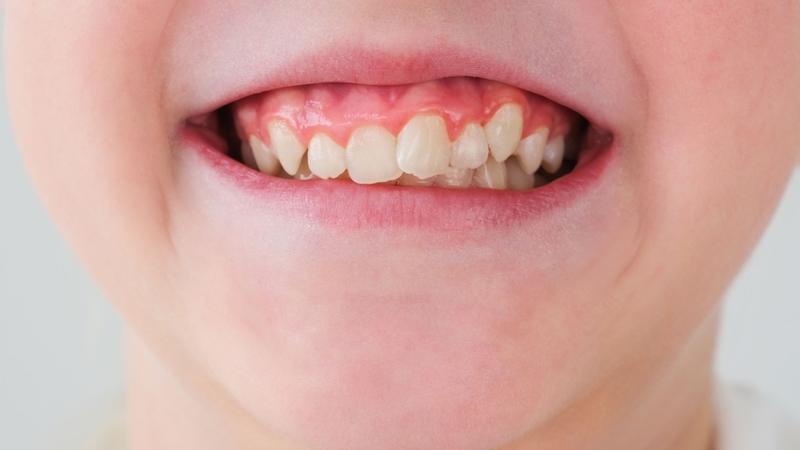 Răng khểnh là răng mọc lệch bất thường, gây khó khăn trong việc vệ sinh