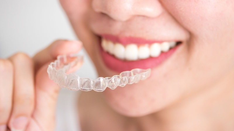 Niềng răng có giúp mũi cao hơn không là thắc mắc phổ biến khi chỉnh nha