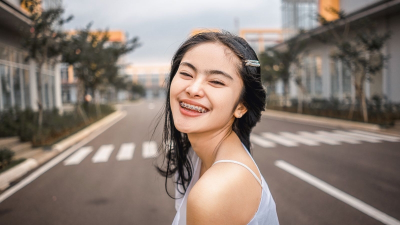 Nhiều người tin rằng sau khi niềng răng, mũi sẽ cao lên rõ rệt