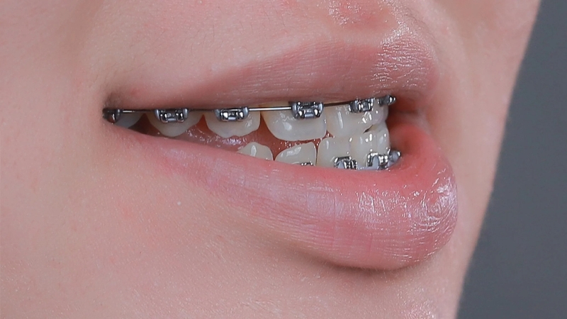 Niềng răng có hết móm không? Ưu điểm niềng răng trong điều trị răng móm 1