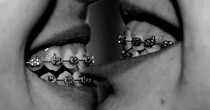 Liệu khi đeo niềng răng có hôn được không 1