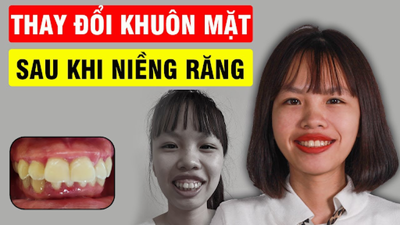 Giải đáp thắc mắc niềng răng có làm thay đổi khuôn mặt hay là không? 2